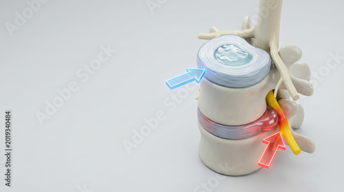 Healthy disc vs herniated disc shows compression on spinal nerve causing pain and discomfort in lower back area with clear anatomical structure and medical illustration