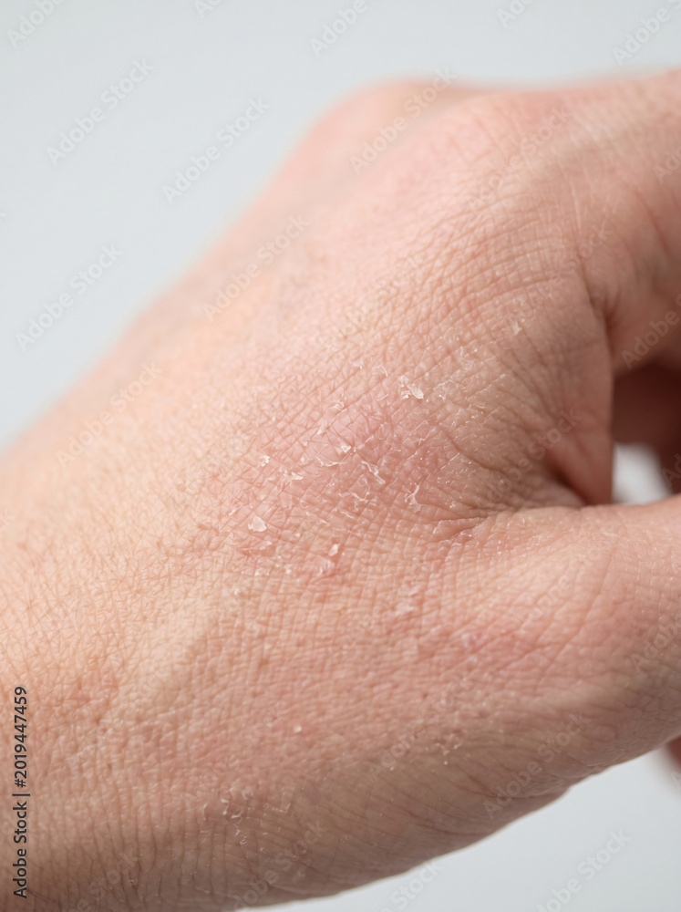 Fototapeta premium Close-Up of Dry Skin on Hand Showing Flakes and Texture Under Natural Light