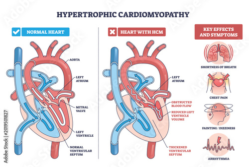 Bild auf Leinwand Hypertrophic cardiomyopathy diagram compares normal and HCM hearts, showing thickened