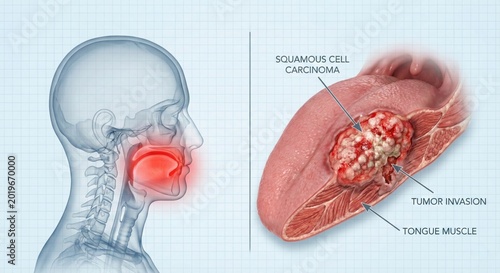 Squamous Cell Carcinoma of the Tongue - Medical Illustration of Oral Cancer.