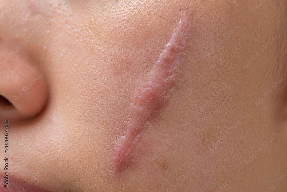 Fototapeta premium Macro Close Up of Raised Facial Scar and Healed Skin Tissue