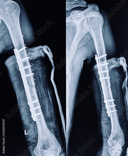 Post-operative radiograph of a left humerus displaying internal fixation of a mid-shaft fracture with surgical staples and bandaging visible.