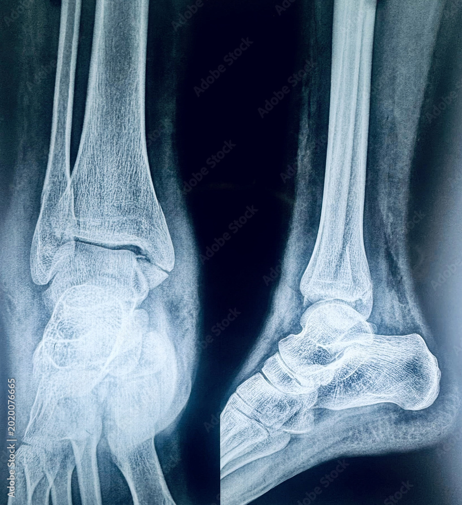 Wall Mural AP and lateral radiograph views displaying a bimalleolar ankle fracture of the tibia and fibula