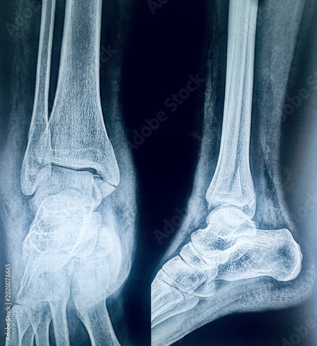 Foto AP and lateral radiograph views displaying a bimalleolar ankle fracture of the tibia and fibula