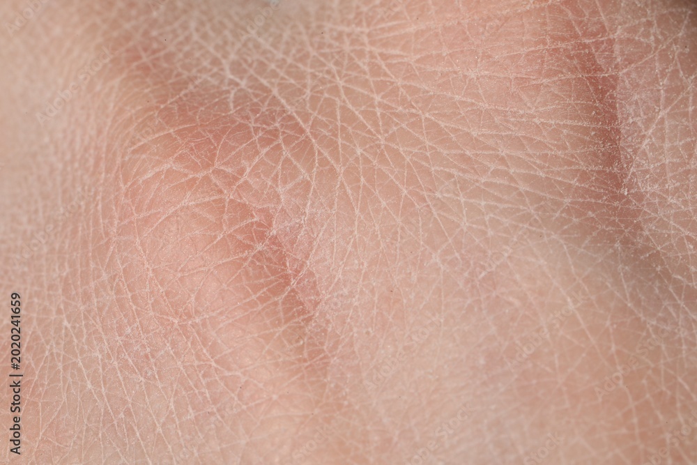 Fototapeta premium Man with dry skin on his hand, closeup