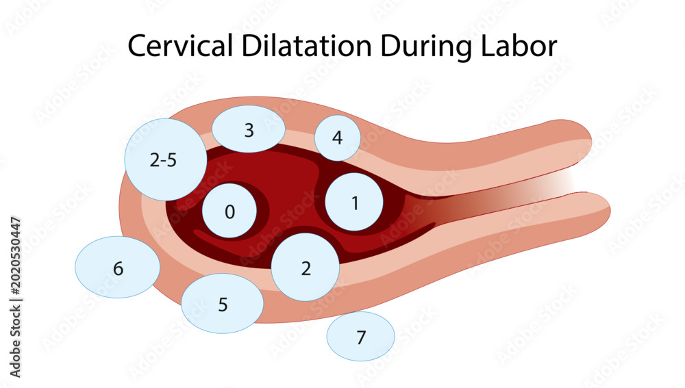 Αυτοκόλλητο Cervical Dilatation During Labor
Obstetric illustration showing fetal station levels and cervical dilatation during labor progression in childbirth