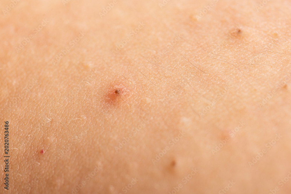Ταπετσαρία Acne on skin closeup photo