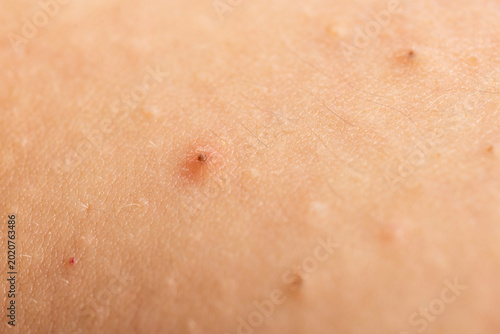 Fotografía Acne on skin closeup photo