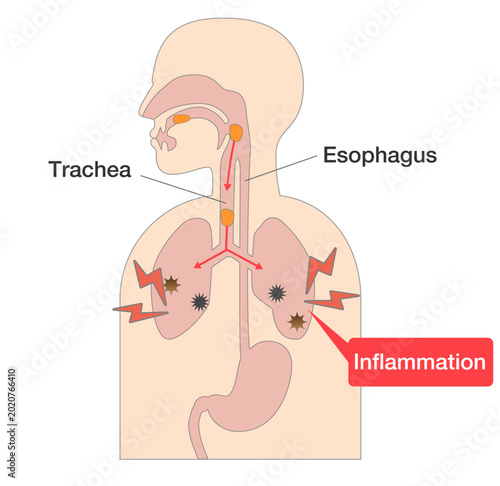 Foto Mechanism of aspiration pneumonia: food entering the trachea and causing inflamm