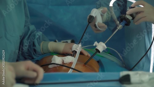 Laparoscopic cholecystectomy instrument. The surgeon's doing laparoscopic gastric sleeve surgery