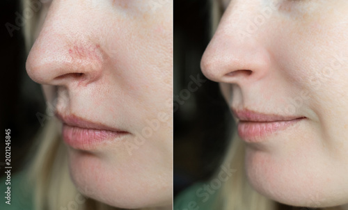 Fotografi Before and after laser couperose removal on nose