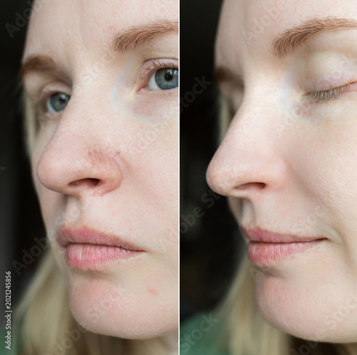 Foto Before and after laser couperose removal on nose