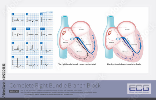 Tableau sur toile The underlying mechanisms of complete right bundle branch block involve either a