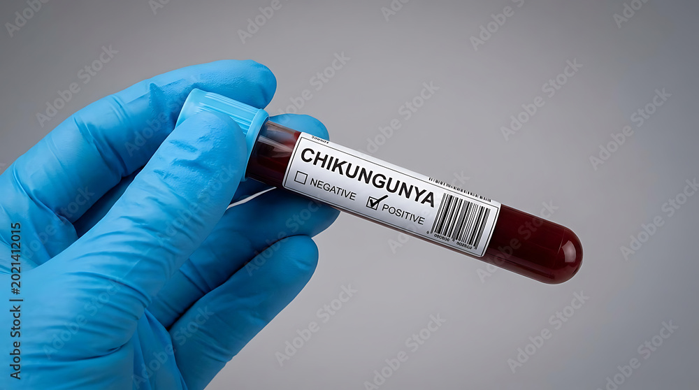 Obraz premium Hand in blue medical glove holding a blood sample test tube with a positive Chikungunya virus result