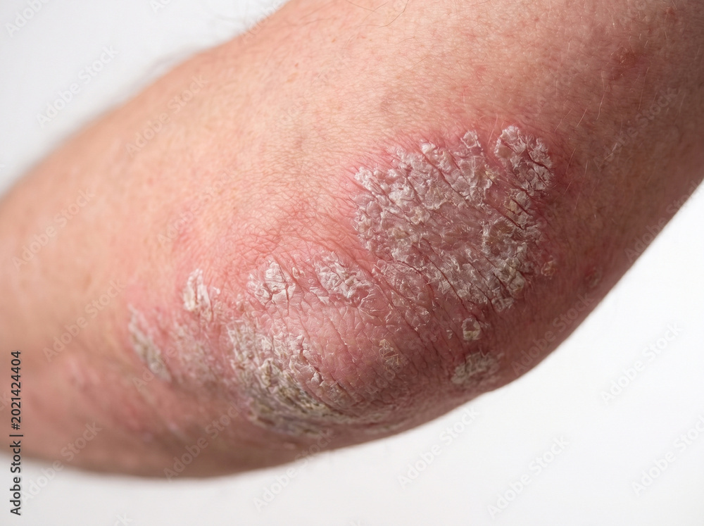 Fototapeta premium Close-up of psoriasis plaques on human elbow showing red inflamed skin with silvery white scaly patches, dermatology skin condition concept