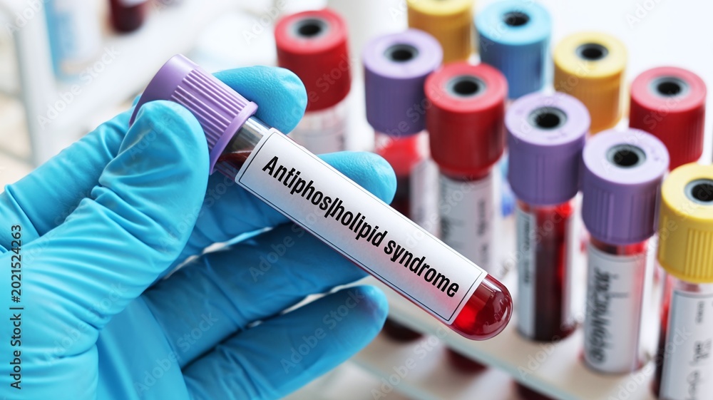 Fototapeta premium Antiphospholipid Syndrome Medical Blood Test Sample in Laboratory for Diagnosis