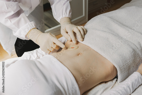 A nurse applies a sticky circle to a patient's colostomy bag.