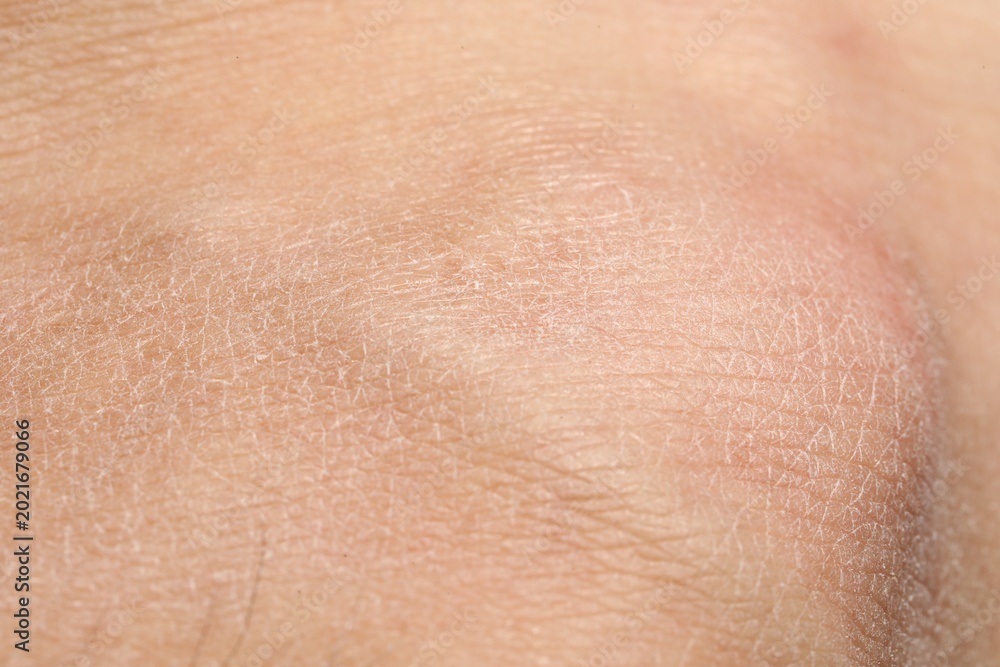 Fototapeta premium Texture of dry skin as background, closeup