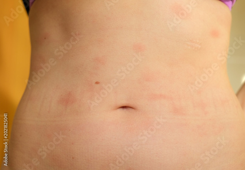 Obraz na płótnie Atopic dermatitis on the abdominal skin of a woman, severe itching on the side