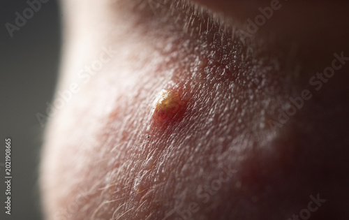 Fotografija Acne on skin closeup photo
