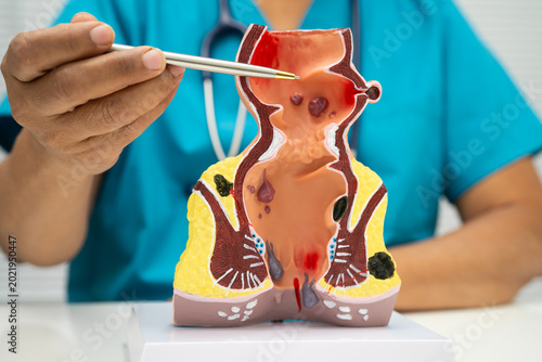 Vászonkép Asian doctor with rectum and hemorrhoid human anatomy model at hospital, inflamed vascular structure