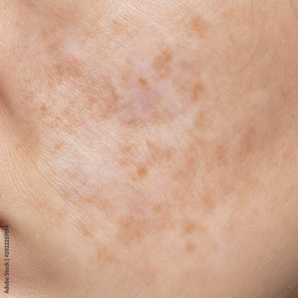 Fototapeta premium Skin close-up showing pigmentation irregularities and spots 