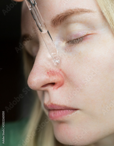 Foto Close-up of woman applying serum with pipette on face with couperose and rosacea symptoms on nose