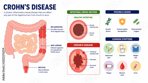 Quadro su tela Crohn’s Disease Digestive Tract and Intestinal Inflammation Infographic