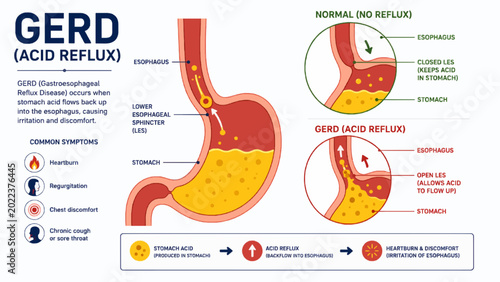 Bild auf Leinwand GERD Acid Reflux Digestive System Medical Infographic