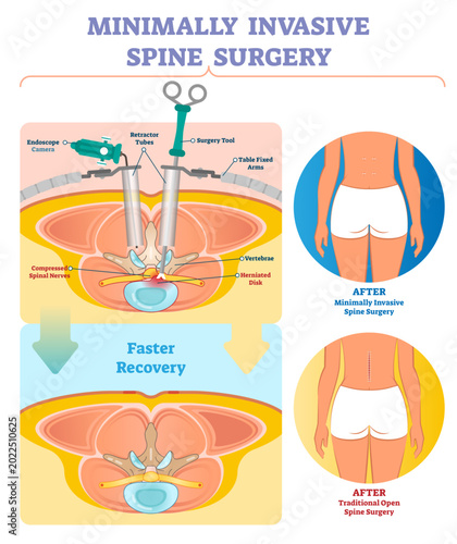 Schilderij op canvas Minimally invasive spine surgery illustration, transparent background