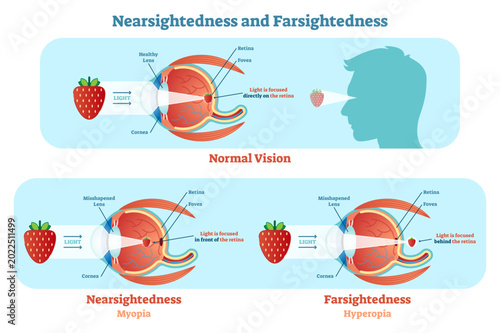 Slika na platnu Far sightedness and Near sightedness illustration diagram, anatomical scheme, transparent background