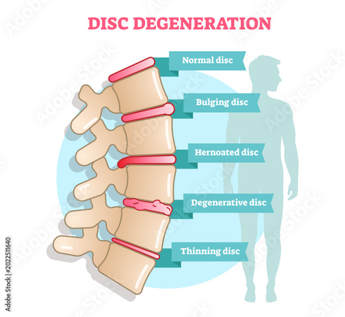 Canvastavla Disc degeneration flat illustration diagram with condition examples - bulging, hernoated, degenerative and thinning disc, transparent background