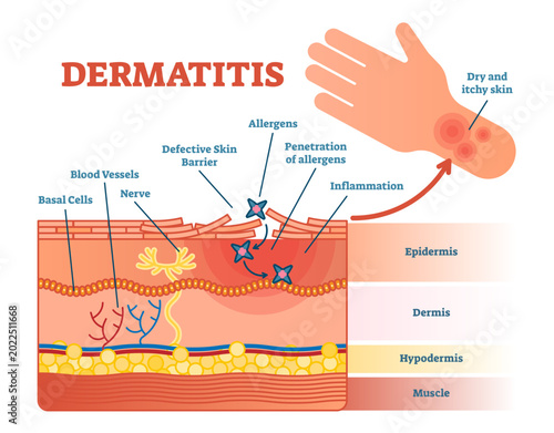 Foto Dermatitis flat illustration diagram with skin layers and allergen movement, transparent background