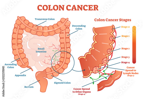 Tableau sur toile Colon cancer medical illustration scheme, anatomical diagram with cancer stages and spreading to other organs, transparent background
