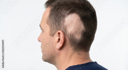 A man showing a distinct bald patch on his scalp, a symptom of alopecia areata, isolated on a white background.