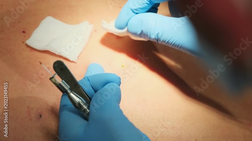 Dermatologist in gloves cleans cut mole place with antiseptic wipe in clinic slow motion. Doctor finishes skin spot treatment in patient back closeup