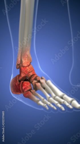 Osteoarthritic Degeneration in Ankle and Foot Joints