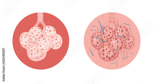 Medical illustration comparing healthy lung alveoli with those affected by infection or chronic obstructive pulmonary disease.