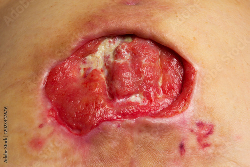 Quadro su tela Close-up medical image of a severe stage 4 pressure ulcer (bedsore, decubitus ulcer) with granulation tissue and signs of chronic inflammation