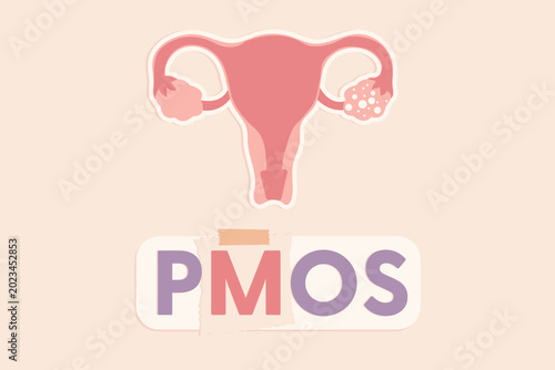 Obraz na płótnie Minimalist flat vector design featuring the acronym PMOS with an anatomical diagram of the uterus and ovaries