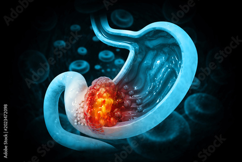 Canvastavla Gastric (stomach) cancer is a malignancy arising from the stomach lining, often caused by abnormal cell growth
