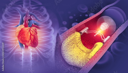 Schilderij op canvas Cholesterol blocked artery with heart. 3d illustration