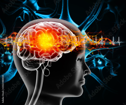 meningitis, serious inflammation of the protective membranes surrounding the brain and spinal cord. Virus or bacteria infection. 3d illustration
