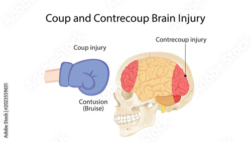 Obraz na plátne Coup and Contrecoup Brain Injury
Medical illustration showing coup and contrecoup brain injuries with cerebral contusions caused by traumatic head impact
