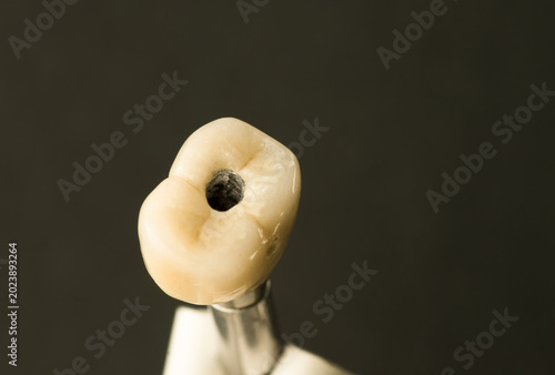 metal ceramic crown with screw fixation on a dental implant