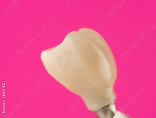 metal ceramic crown with screw fixation on a dental implant