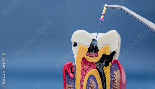 Fotografie Endodontic root canal treatment concept: tweezers inserting a dental file into a cross-section tooth model with deep caries