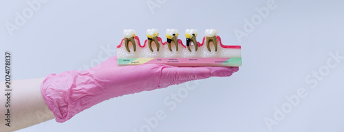 Dentist hand holding a periodontal disease model. Stages of gingivitis and periodontitis anatomy concept.