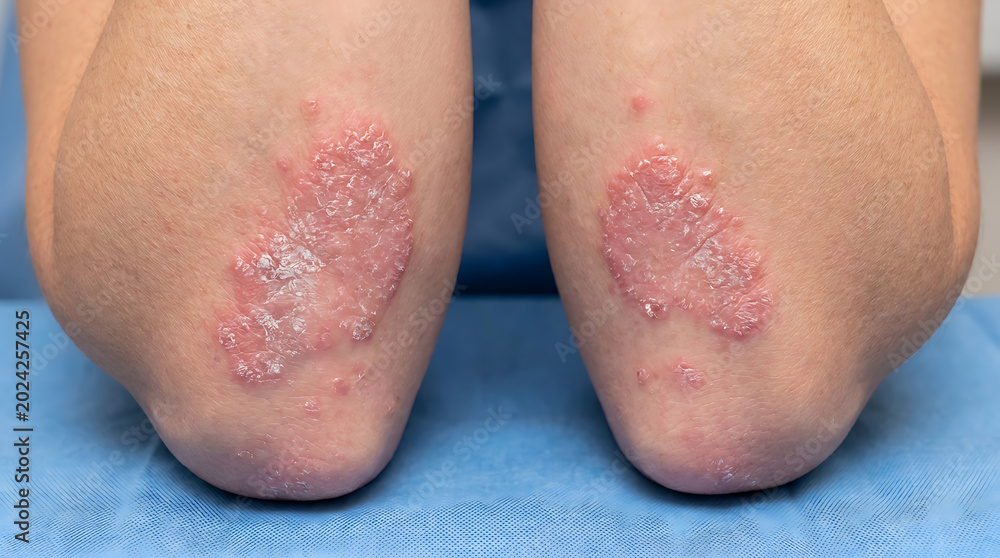 Naklejka premium Close up of elbows with red, scaly patches indicating a skin condition like psoriasis