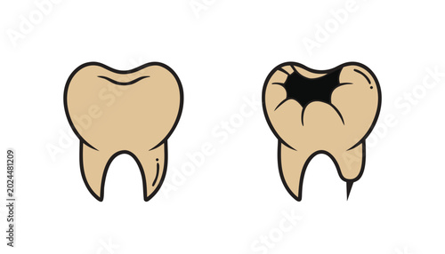 Konstfotografi Dental caries progression illustration featuring healthy tooth beside damaged molar with large black cavity and root infection